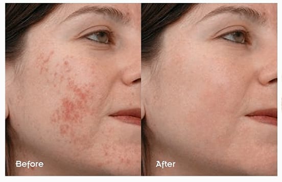 The Ordinary Niacinamide 10% + Zinc 1% – 20ml Serum