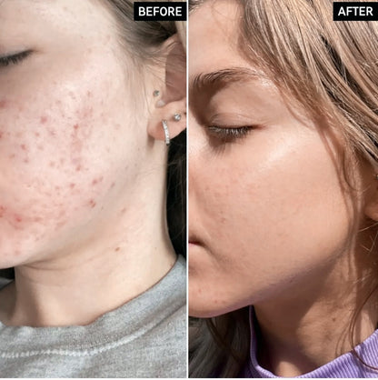 The Ordinary Niacinamide 10% + Zinc 1% – 20ml Serum